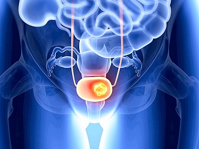 Urinary Tract (Transitional Cell Carcinoma) & Bladder Cancer