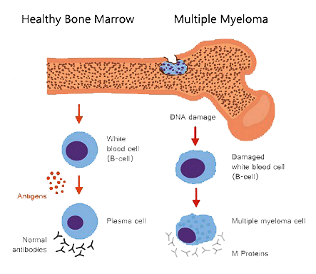 Multiple Myeloma