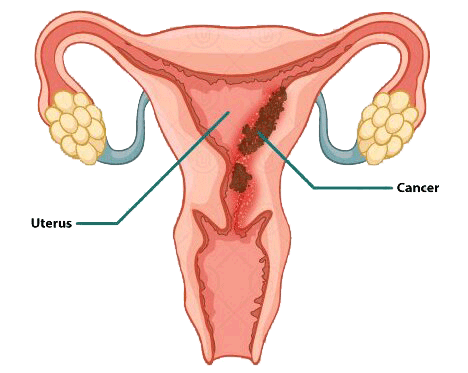 Carcinoma of Uterus