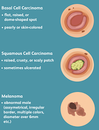 Skin Cancer