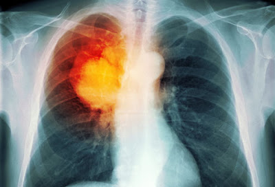 Bronchogenic Carcinoma (Lung Cancer)